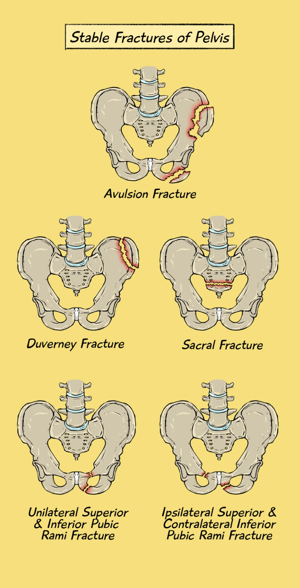 Stable Fractures Pelvis
